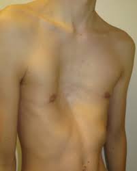 Image result for Pectus Excavatum