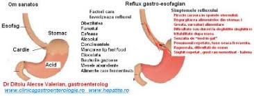 Nod in gat cauze tratament și remedii naturiste. Aliniere Elev Ars Senzatie De Nod In Gat Dupa Masa Butlercarriers Com