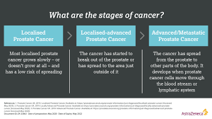 Metastatic prostate cancer is an advanced form of cancer (stage 4) in which the cancer cells have spread from the prostate to other areas of the body. Prostate Cancer