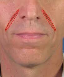 On the off chance that you favor utilizing a smooth treatment to whisk away your wrinkles,. Smile Line Treatment San Diego Ca