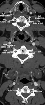 00:57 artery diagram 01:21 arteriole diagram. Axial Images At The Level Of C4 C5 C6 Vertebrae Showing The Medial Download Scientific Diagram