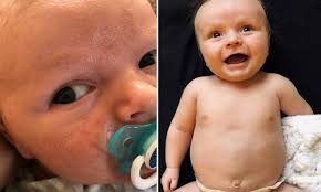 We did not find results for: Newborn Whose Skin Erupted In Acne Now Has A Clear Complexion Thanks To A 7 99 Coconut Oil Daily Mail Online