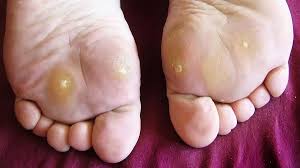 Multiple recalcitrant warts (more than five warts and resistant to many therapeutic modalities) 12 have a significant morbidity by inducing discomfort both physically and psychologically 13. Symptoms Causes And Treatment For Plantar Warts