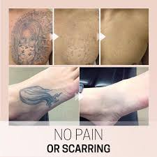 Put this mixture on your tattoos for 10 minutes. Tateraser Tattoo Removal Cream Fancyberrie