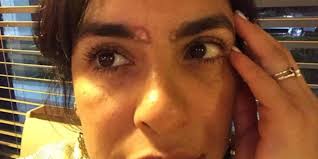 La actriz Liz Gallardo sufre quemaduras en las cejas al someterse a  procedimiento estético