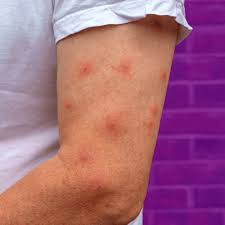 Image result for bedbugs bites