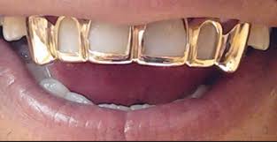 For our calculation we will assume a spot gold price of $1000 per ounce. Silver Tooth Cap Prices Dental News Network