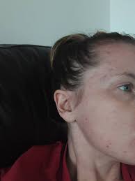 On 4th week of taking sulfasalazine, rheumatology rang me earlier as they  were aware of these itchy spots and rash, been told to stop taking it for a  week until my next