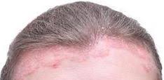 The itchiness accompanied by hair thinning is more likely caused by dermatitis, or skin irritation, chacon says. Seborrheic Dermatitis Village Dermatology