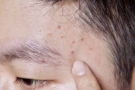 Image result for folliculitis symptoms