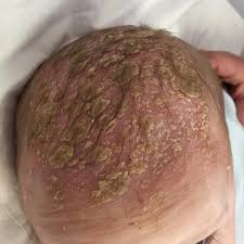 Image result for Cradle Cap
