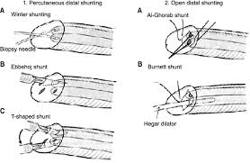 Image result for Priapism