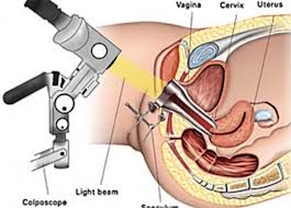 Image result for Colposcopy Findings