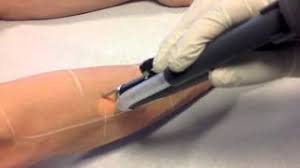 Epilation durable au meilleur rapport qualité/prix ! Epilation Laser Definitive Bras Chez La Femme Cabinet Epilation Laser Rouen A Une Heure De Paris Youtube