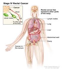If there are signs of metastasizing to other areas of the body or your cancer is at an advanced stage, your doctor may also recommend radiation, chemotherapy, or other therapy. Rectal Cancer Treatment Pdq Patients Siteman Cancer Center