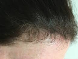 Prolonged stress can result in hair loss, but it is the type of stress that lasts months/years and typically affects your overall mental and physical health in a noticeable way. Diffuse Alopecia Dermnet Nz