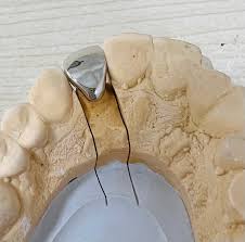 被せ物の種類（FMC・CADCAM・HR） | 市原市 ハローたつみ台デンタルクリニック