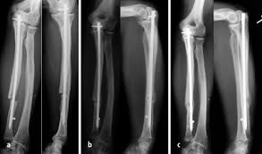 Intramedullare Nagelosteosynthese Der Ulna In Der Revisionschirurgie Springerlink