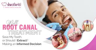 Will Root Canal Treatment Save My Tooth, Or Should I Extract? Making An  Informed Decision