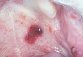 Blood blisters are a common, minor skin condition. Oral Blood Blisters Exodontia