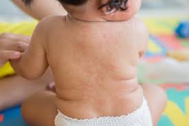 Erupciones Formas Colores Y Muchas Causas Familia Y Salud