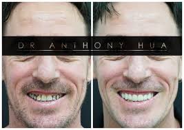 Cosmetic Dentistry Burleigh