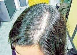 Rambut gugur atau kebotakan biasanya berlaku disebabkan akar rambut rosak atau mati menghalang pertumbuhan rambut baru. Langkah Ajaib Merawat Rambut Gugur Faith Fleur