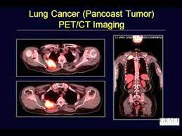 The test has only a limited ability to detect small tumors. Gracecast 015 Cancer 101 David Djang Interview On Pet Scans Youtube