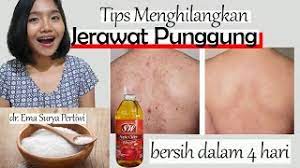 Banyak cara yang dilakukan orang untuk menghilangkan jerawat. Tips Jerawat Punggung Hilang Dalam 4 Hari Murah Meriah Emasuperr Youtube