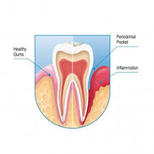 Once the tooth has been pulled, a blood clot usually forms continue to brush and floss your teeth, and brush your tongue, but be sure to avoid the extraction site. Bleeding Gums Loose Teeth Ealing Dentist Acton Hanwell