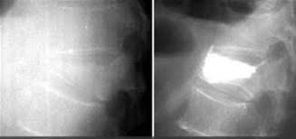 Vertebral compression fractures (vcfs) are the most common complication of osteoporosis, affecting more than 700,000 americans annually. Osteoporotic Vertebral Compression Fracture Spine Orthobullets
