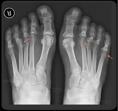 Image result for XRay Changes in Rheumatic Conditions