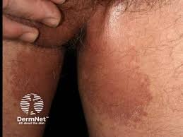 Image result for Erythrasma