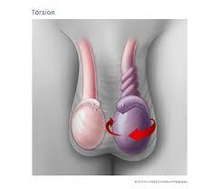 Testis Torsiyonu Prof Dr Hakki Perk