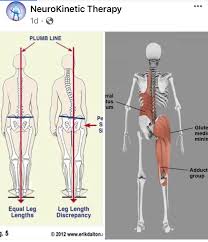 Image result for Functional Leg Length Discrepancy