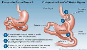 Pin On Gi Illnesses And Disorders