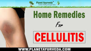 9 Home Remedies For Cellulitis Bacterial Skin Infection Cellulitis Infection Is Conside Skin Infection Remedy Cellulitis Infection Cellulitis Remedies