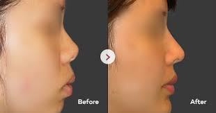 Nose Surgery By Type Vip Plastic Surgery Korea
