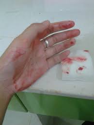 Segera lakukan pengobatan jika telah terjadi infeksi, atau ketika dokter melihat infeksinya bertambah parah. Pita Susi Wiyoga Pitawiyoga Twitter