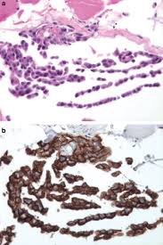 Roughly 50% are malignant epithelioid mesothelioma (epithelial cells) which has a better prognosis (outlook). Utility Of D2 40 A Novel Mesothelial Marker In The Diagnosis Of Malignant Mesothelioma Modern Pathology