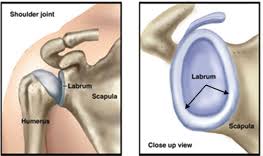 Your doctor will do a physical exam and may order imaging studies, including an mri or a simple surgical procedure called arthroscopy.if you have what is known as a slap tear, which stands for superior labrum anterior posterior, it means the top part of your labrum is torn. Shoulder Dislocation And Instability Labrum Tear Huang Orthopaedics