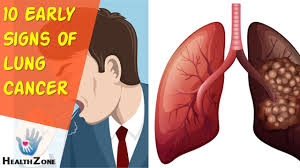 No one really knows, as you can't be sure when the cancer first showed up, says alex little, md, a thoracic surgeon with a special interest in esophageal. What Are The Early Signs Of Lung Cancer Women Fitness Magazine