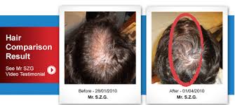 Read verified and trustworthy customer reviews for sir 101 hair restoration specialists of calgary or write your own review. Frequently Asked Questions