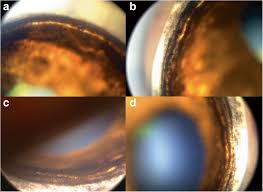 Is caused by blocked drainage canals, resulting in a sudden rise in intraocular pressure. Primary Angle Closure Glaucoma With Goniodysgenesis In A Beagle Dog Bmc Veterinary Research Full Text