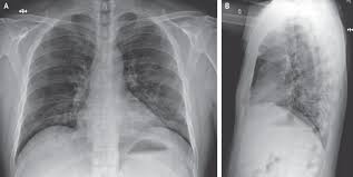 Ca sĩ việt quang đã phát bệnh. Ä'áº·c Ä'iá»ƒm Hinh áº£nh Xquang Viem Phá»•i Do Corona Virus Há»™i Ä'iá»‡n Quang Va Y Há»c Háº¡t Nhan