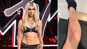 Taylor Momsen Hospitalized After Venomous Spider Bite on AC/DC Tour
