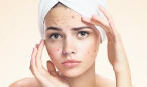 Sebelum kita terus ke bahagian rawatan, harus difahami dahulu perbezaan antara parut jerawat dan bintik hitam akibat jerawat. Parut Jerawat Tak Bahaya Tapi Perlu Dirawat