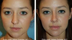 Broad wings rhinoplasty bulbous nose tip is recommended between the ages of 18 to 40 years, but there are exceptions to. Tip Rhinoplasty Reduction Of The Bulbous Tip Video Dailymotion