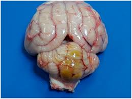 Image result for Kernicterus