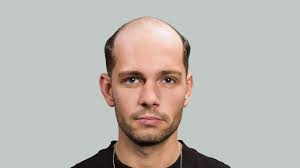 Total Cover Plus Hair System Manchester